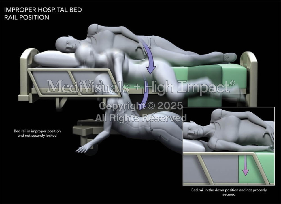 Fall from Hospital Bed