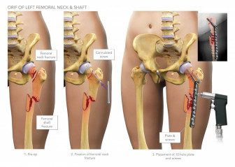 ORIF of Femor Fractures