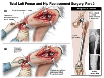 Total Left Femur and Hip Replacement Surgery