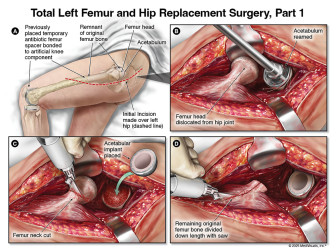 Total Left Femur and Hip Replacement