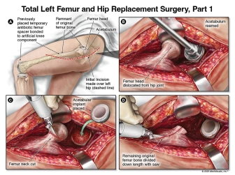Total Left Femur and Hip Replacement