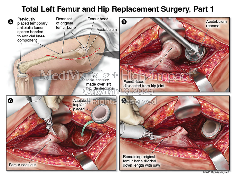 Total Left Femur and Hip Replacement