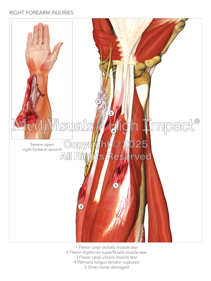 $18M Verdict: Illustrating Severe Injuries and Surgeries Following Fall in Parking Lot