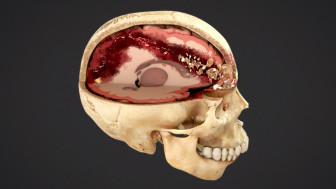Summary of Gunshot Wounds