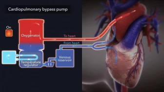 Cardiopulmonary Bypass