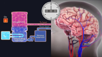 Cerebral Protection before Circulatory Arrest