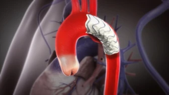 Thoracic Endovascular Aortic Repair (TEVAR)
