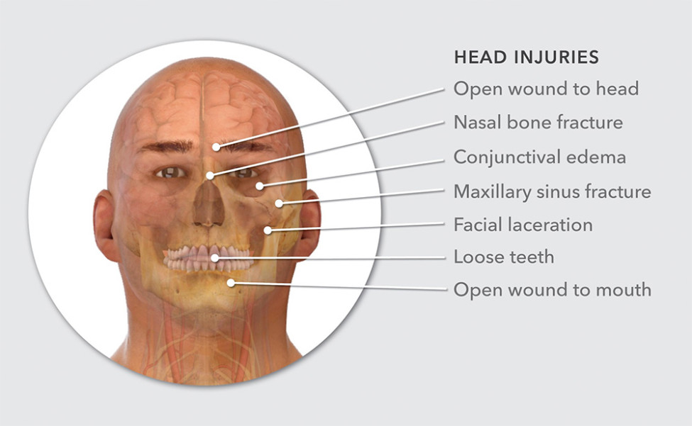 $3.5M Verdict: Summary of Injuries Presentation Aids In Securing Jury Verdict