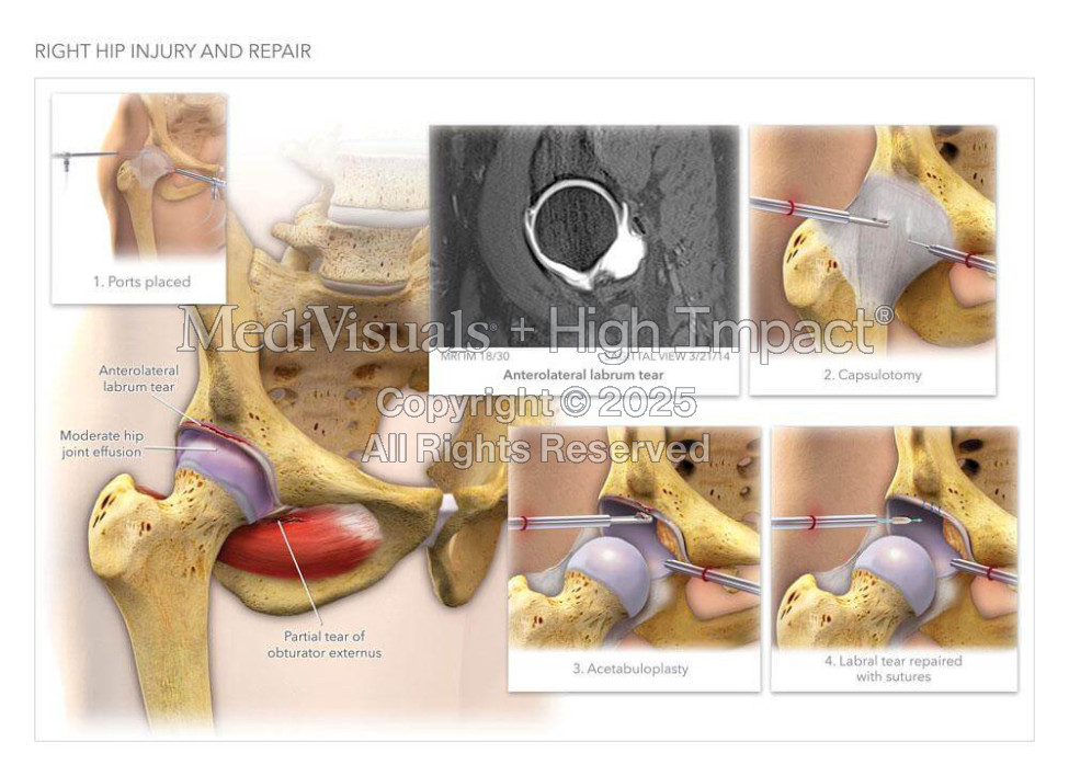 $2.4M Verdict: Illustrating Ankle Fractures After Drunk Driving Crash