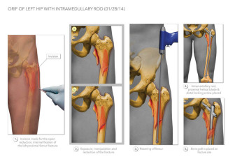Hip ORIF with Intramedullary Rod