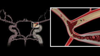 Carotid Dissection and Propagated Clot