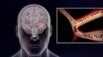 Transient Ischemic Attack and Stroke