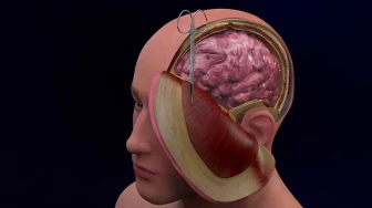 Hemicraniectomy with Decompression