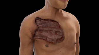 Necrotizing Fasciitis from Infected Needle