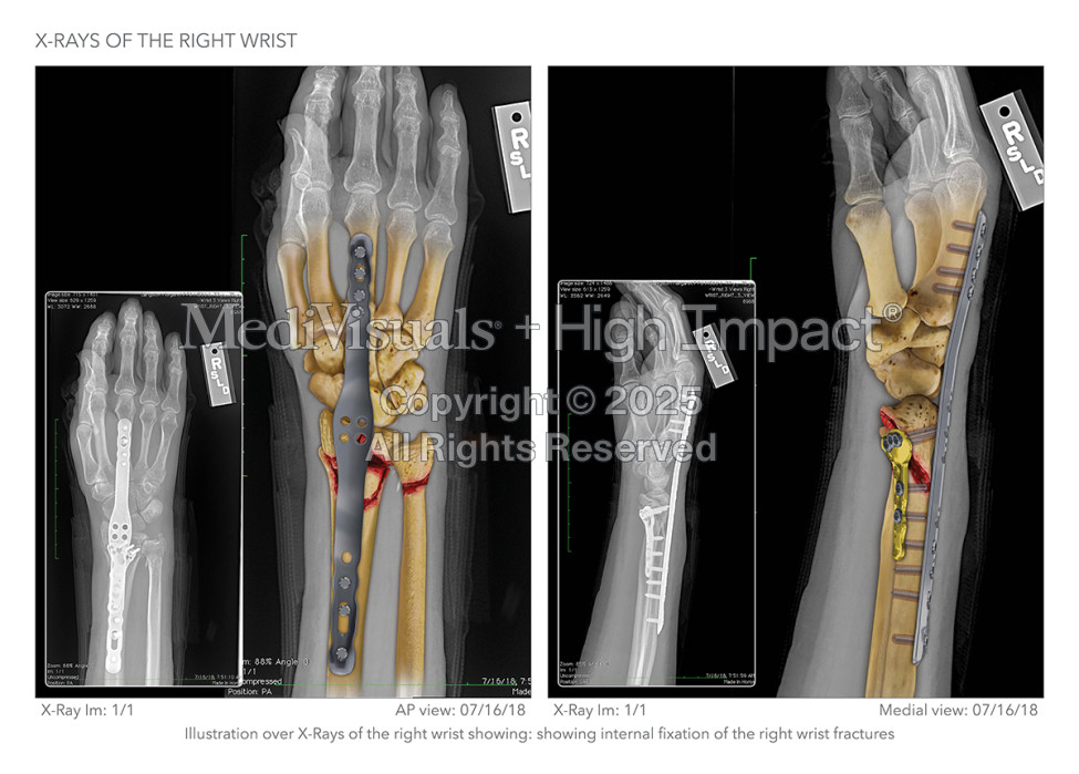 $525K Settlement: Illustrating Wrist Injury After Fall Down Stairs