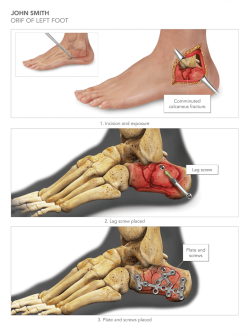 ORIF of Left Foot