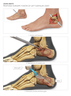 Proposed Surgery: Fusion of Left Subtalar Joint