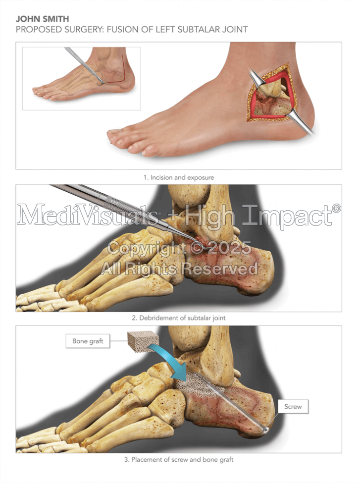 Proposed Surgery: Fusion of Left Subtalar Joint