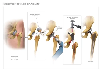 Left Total Hip Replacement