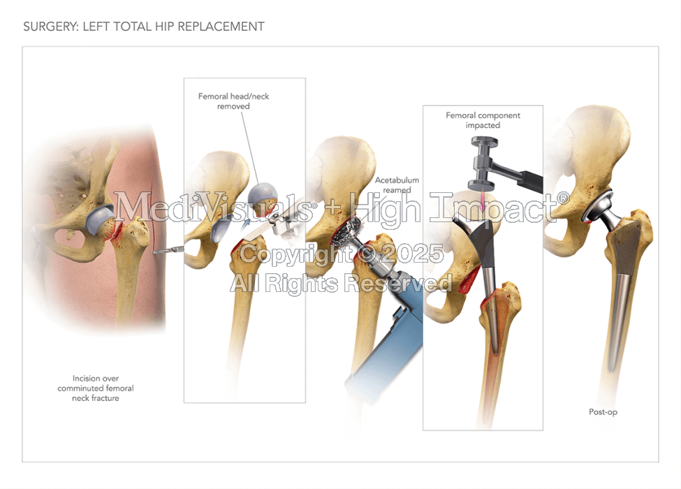 Left Total Hip Replacement