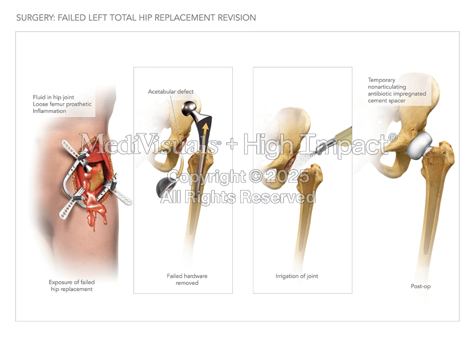 Failed Left Total Hip Replacement Revision