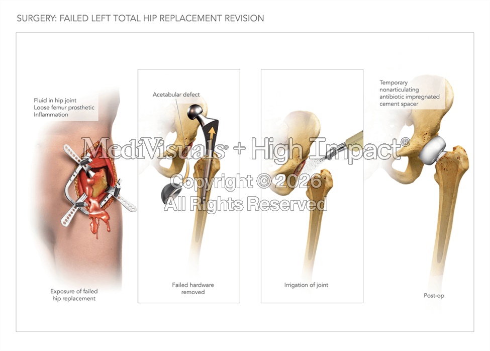 Failed Left Total Hip Replacement Revision