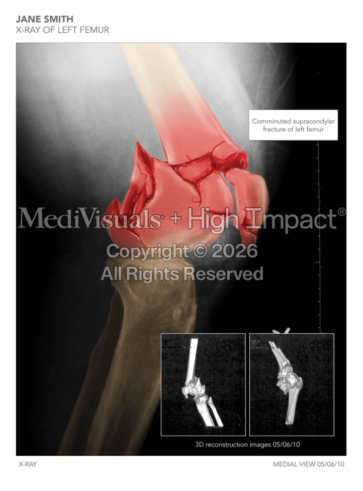 X-Ray of the Femur