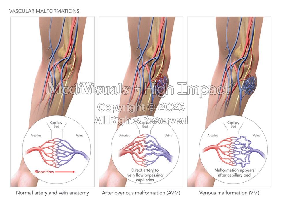 Vascular Malformations with Embolization