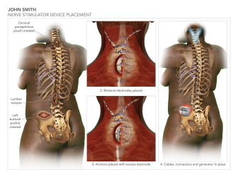 Nerve Stimulator Device Placement