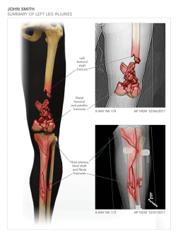 Summary of Left Leg Injuries