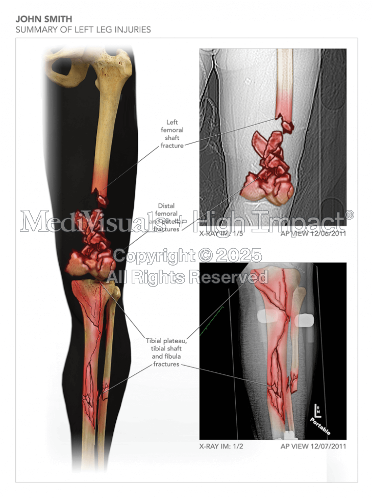 Summary of Left Leg Injuries