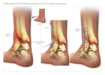 ORIF of Lateral Malleolus