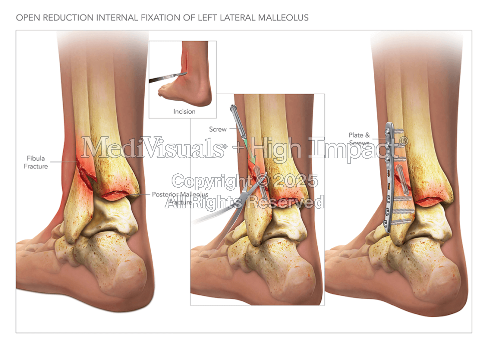 ORIF of Lateral Malleolus