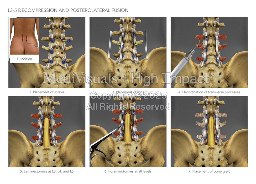 L3-5 Decompression and Posterolateral Fusion