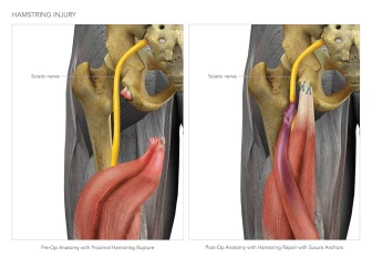 Hamstring Rupture and Repair