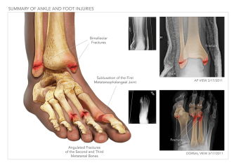 Summary of Ankle and Foot Injuries