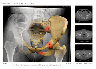 Pelvic Fracture Illustration