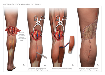 Traumatic Leg Wound and Repair