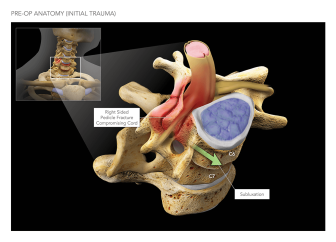 Cervical Spine Subluxation with Pedicle Fracture