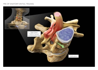 Cervical Spine Subluxation with Pedicle Fracture