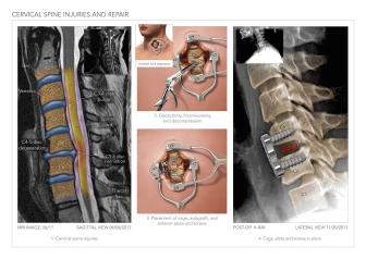 Cervical Spine Injuries & Repair