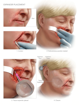 Revisional Scar Surgery