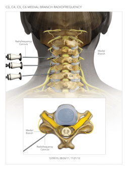Medial Branch Radiofrequency Pain Management