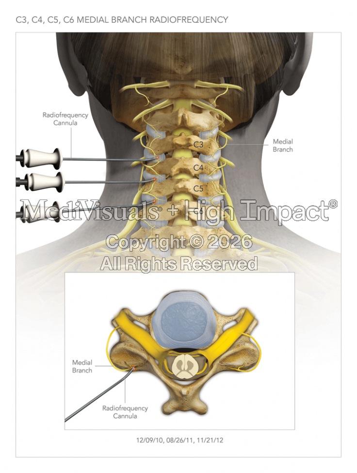Medial Branch Radiofrequency Pain Management