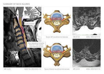 Neck Injury & Surgery