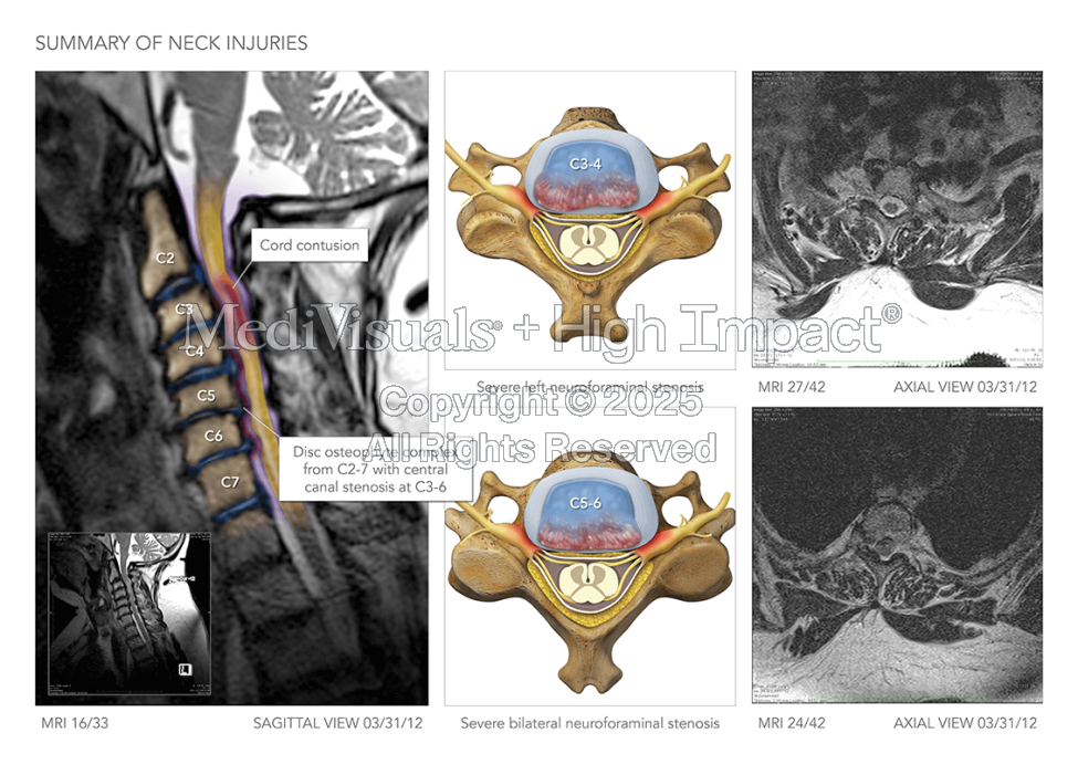 Neck Injury & Surgery