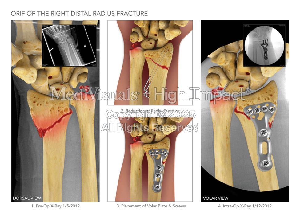 ORIF of Right Distal Radius Fracture
