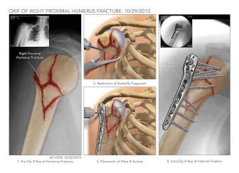 ORIF of Right Proximal Humerus Fracture