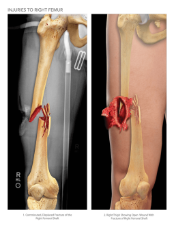 Injuries and Repair of the Right Femur