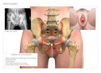 Pelvic and Residual Injuries